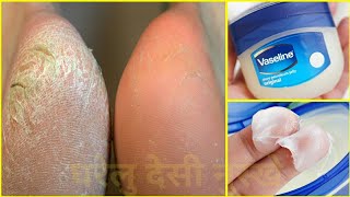 Vaseline सिर्फ 2 बार में फटी एड़ियों को कोमल बना देगा ये नुस्खा  Cracked Heels Treatment [upl. by Anelyak882]