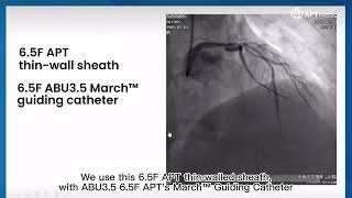 Clinical Cases of 65F March™ Guiding Catheter [upl. by Hakim666]