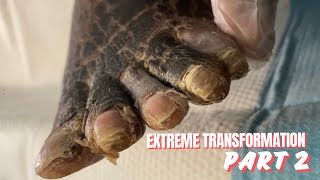 EXTREME FOOT TRANSFORMATION FINAL RESULT  PART 2 [upl. by Darrey271]