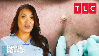 The BEST Blackhead Pops  Dr Pimple Popper  TLC [upl. by Philpot]