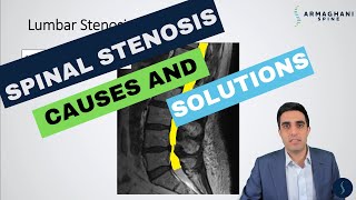 Lumbar Spinal Stenosis  What is the cause and how will I get better [upl. by Borer]