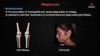 Ochronosis or Alkaptonuria  Usmle step 1 lecture [upl. by Kilam960]