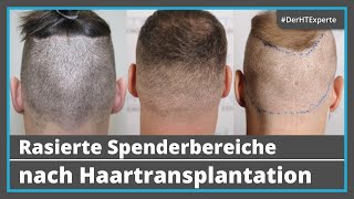 Nach Haartransplantation Wie kurz kann man die Haare noch tragen 10 rasierte Entnahmebereiche [upl. by Neerac]