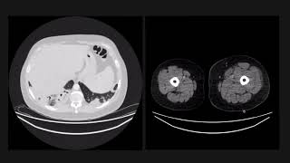 Cavitating lung lesions are a classic exam case [upl. by Latsyrcal]