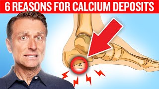 6 Reasons for Calcium Deposits Spurs Osteophytes Stones and Tartar [upl. by Demott152]