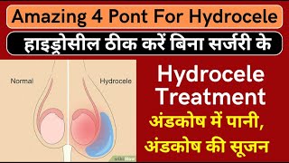 Hydrocele treatment  हाइड्रोसील ठीक करें बिना सर्जरी के  Treat Hydrocele with Naturally [upl. by Demona221]