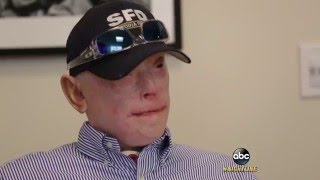 SeverelyBurned Former Firefighter Opts for Face Transplant Part 1  ABC News [upl. by Hullda]