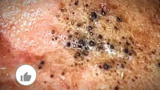 Most Satisfying CloseUp Blackhead Removal 2024 [upl. by Ebarta]