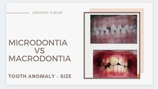 DEVELOPMENTAL DISTURBANCES OF TEETH  PART 1SIZE [upl. by Draillih951]