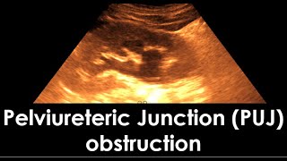 Pelviureteric Junction PUJ obstruction  dilatation of the pelvicaliceal system  Hydronephrosis [upl. by Mellins575]