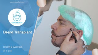 Beard Transplant in Turkey 4 Hours  Turk Aesthetic [upl. by Rubetta]