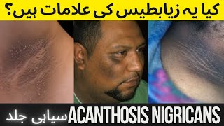 Acanthosis Nigricans Causes  Symptoms Treatment [upl. by Annav]