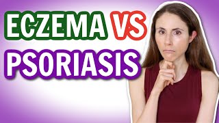 ECZEMA VS PSORIASIS HOW TO TELL THE DIFFERENCE 🤔 DrDrayzday [upl. by Denis]