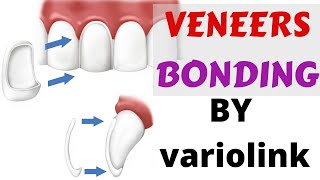 Veneers Bonding Cementation luting Protocol variolink ivoclar n instructions and guide with steps [upl. by Noroj396]