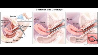 Gestational trophoblastic disease MANAGEMENT [upl. by Klaus722]