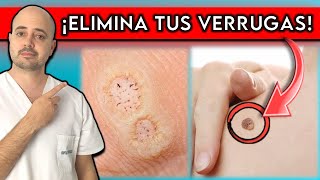 ELIMINA tus VERRUGAS en menos de 1 SEMANA  4 Remedios NATURALES que FUNCIONAN [upl. by Fougere]