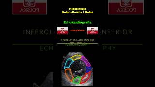 Echokardiografia  Hipokinezja DolnoBoczna I Dolna [upl. by Analad]