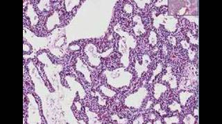 Histopathology Lung Interstitial pneumonia [upl. by Odawa839]