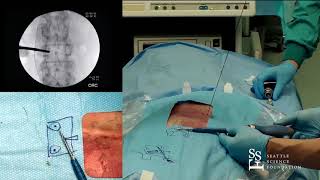 Percutaneous Screw Placement  Hyun Bae MD [upl. by Hubsher]