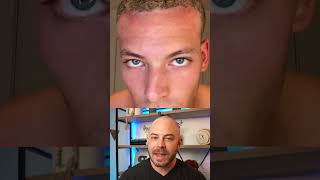 Doctor reacts to dermarolling routine for hair growth hairloss dermreacts doctorreacts [upl. by Aenat]