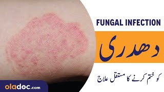 How To Remove Fungal Infection Urdu Hindi DaadDadri Ka Ilaj  Ringworm Removal  Chambal Ka Ilaj [upl. by Anirbak50]