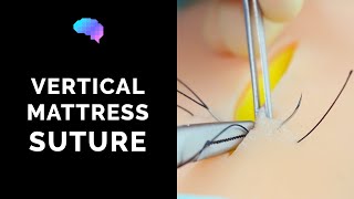 Vertical Mattress Suture  OSCE Guide  UKMLA  CPSA [upl. by Adiell136]