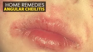 Angular Cheilitis  Home Remedies Natural Treatment  Health Education [upl. by Neumann756]