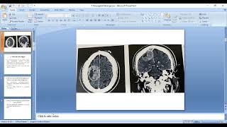 5 Parasagittal meningioma [upl. by Ielhsa]