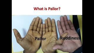 What is Pallor in Medicine  Where to Look for Pallor [upl. by Attennod]