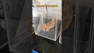 Cancer stomach specimen mounting  புற்றுநோய் வயிறு [upl. by Kitrak316]