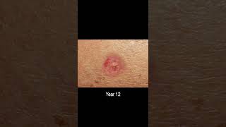 Basal Cell Carcinoma Skin Cancer Development Time Lapse Normal to Cancer Over 25 Years [upl. by Eniamahs]