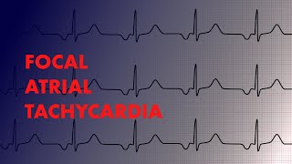 Focal Atrial Tachycardia  EKG Interpretation  MEDZCOOL [upl. by Tenom791]