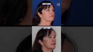 Blepharoplasty Before and After Patient 3053 [upl. by Westbrook705]