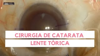 Vídeo de Cirurgia de Catarata com Implantação de Lente Intraocular Tórica  Dr Olho [upl. by Ahsit]