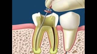 Absceso alveolar crónico Diagnóstico y tratamiento [upl. by Asnarepse]