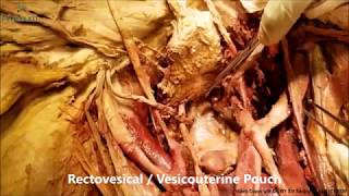 BLADDER Ligaments Detrussor TRIGONE DUCTUS URETER Clinicals – Sanjoy Sanyal – Proceum [upl. by Attlee]