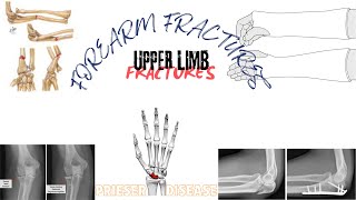 UPPER LIMB FRACTURES PART2 FOREARM AND WRIST FRACTURES shamim dogar orthopedics [upl. by Eelreveb]