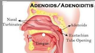 Adenoiditis in hindi 100 [upl. by Akkahs]