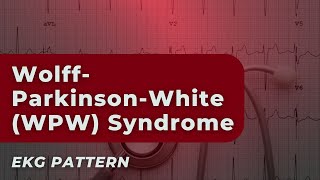 WolffParkinsonWhite WPW Syndrome Understanding Your EKG ECG [upl. by Ahsael]