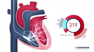 Implantable Cardioverter Defibrillator  How it works [upl. by Darcie]