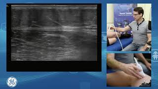 Sonographic assessment of the lateral knee for POCUS clinicians [upl. by Gillett]