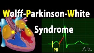 WolffParkinsonWhite Syndrome Pathophysiology PreExcitation and AVRT Animation [upl. by Turnbull]