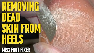 Foot scraping How to remove dead skin from heels in Minutes full treatment by miss foot fixer [upl. by Fesoy]