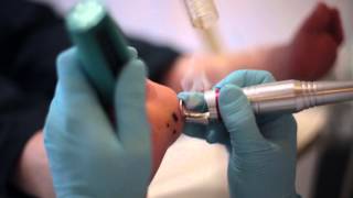 Laser treatment of Verruca [upl. by Ybocaj]