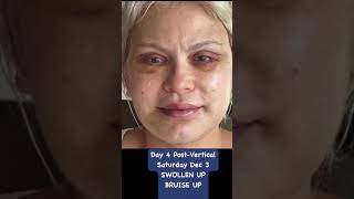 DayByDay Facelift Recovery amp Transformation [upl. by Kim]