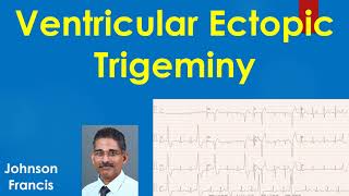 Ventricular Ectopic Trigeminy [upl. by Warwick]