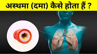 अस्थमा दमा की बीमारी कैसे होती हैं  Asthma etiology amp pathophysiology [upl. by Restivo]