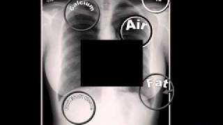 LearningRadiology 01 5 Radiographic Densities [upl. by Nosdivad756]