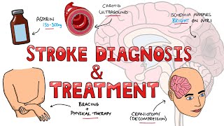 Stroke Diagnosis and Treatment  Acute and Long Term Treatment of Ischemic and Hemorrhagic Stroke [upl. by Notluf]