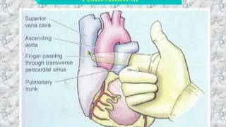 34 Transverse sinus of pericardium [upl. by Eniretac39]